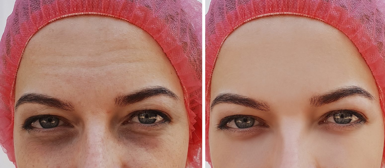 لا ليستا مشكلة واحدة.. اعرفي الفرق بين الهالات السوداء والانتفاخات تحت العين وطريقة التخلص منهما