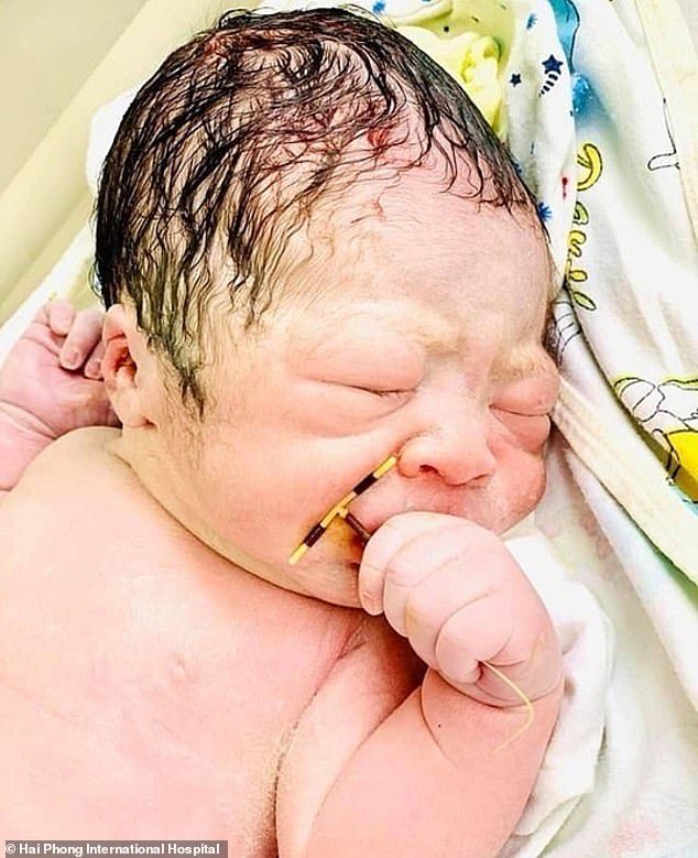 استخدمت لولباً لمنع الحمل فخرج طفلها ممسكاً به! صورة مثيرة لرضيع حديث الولادة