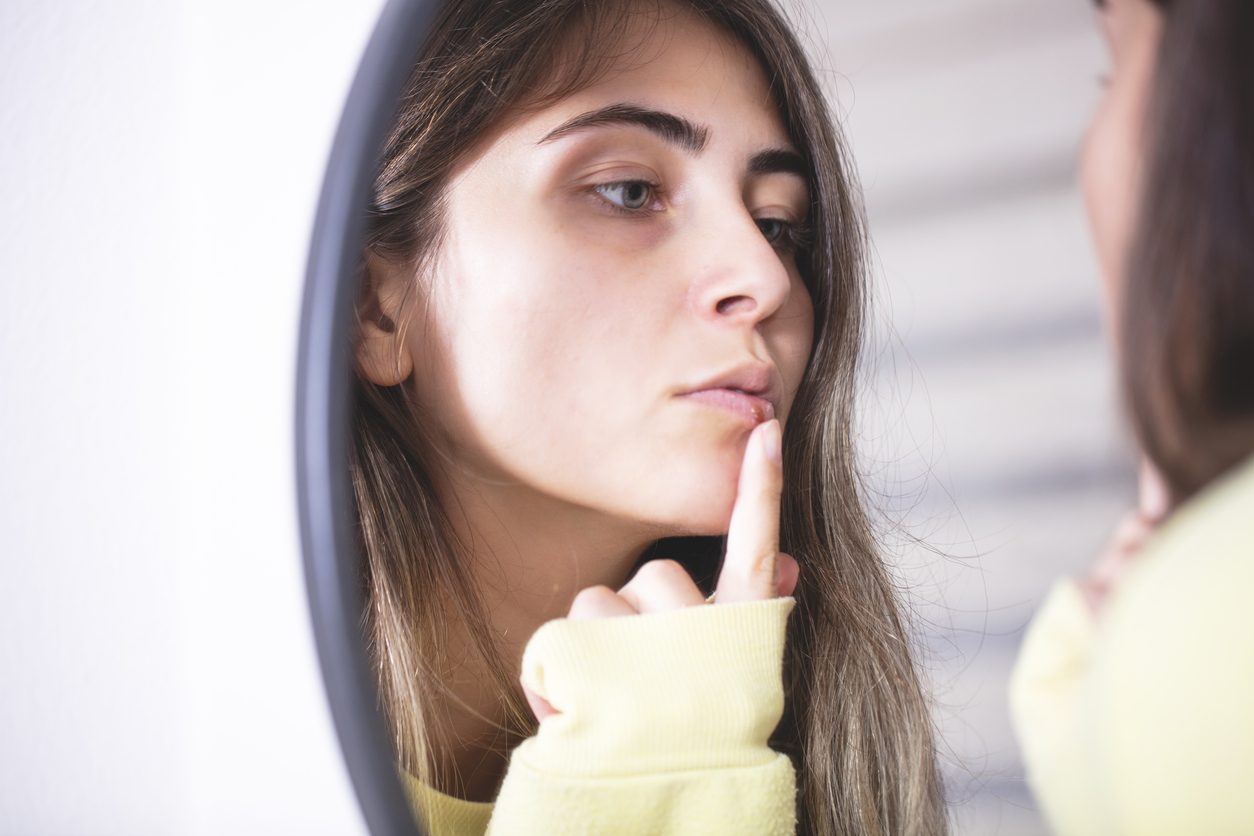 هكذا تعالجين قروح البرد أو بثور الحمى بطرقٍ طبيعية