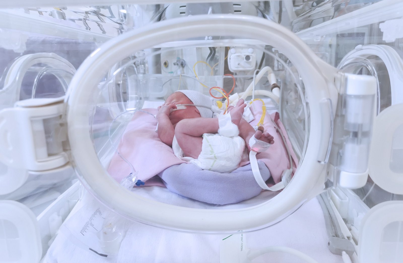 طفلة تولد وفي داخل بطنها توأمها