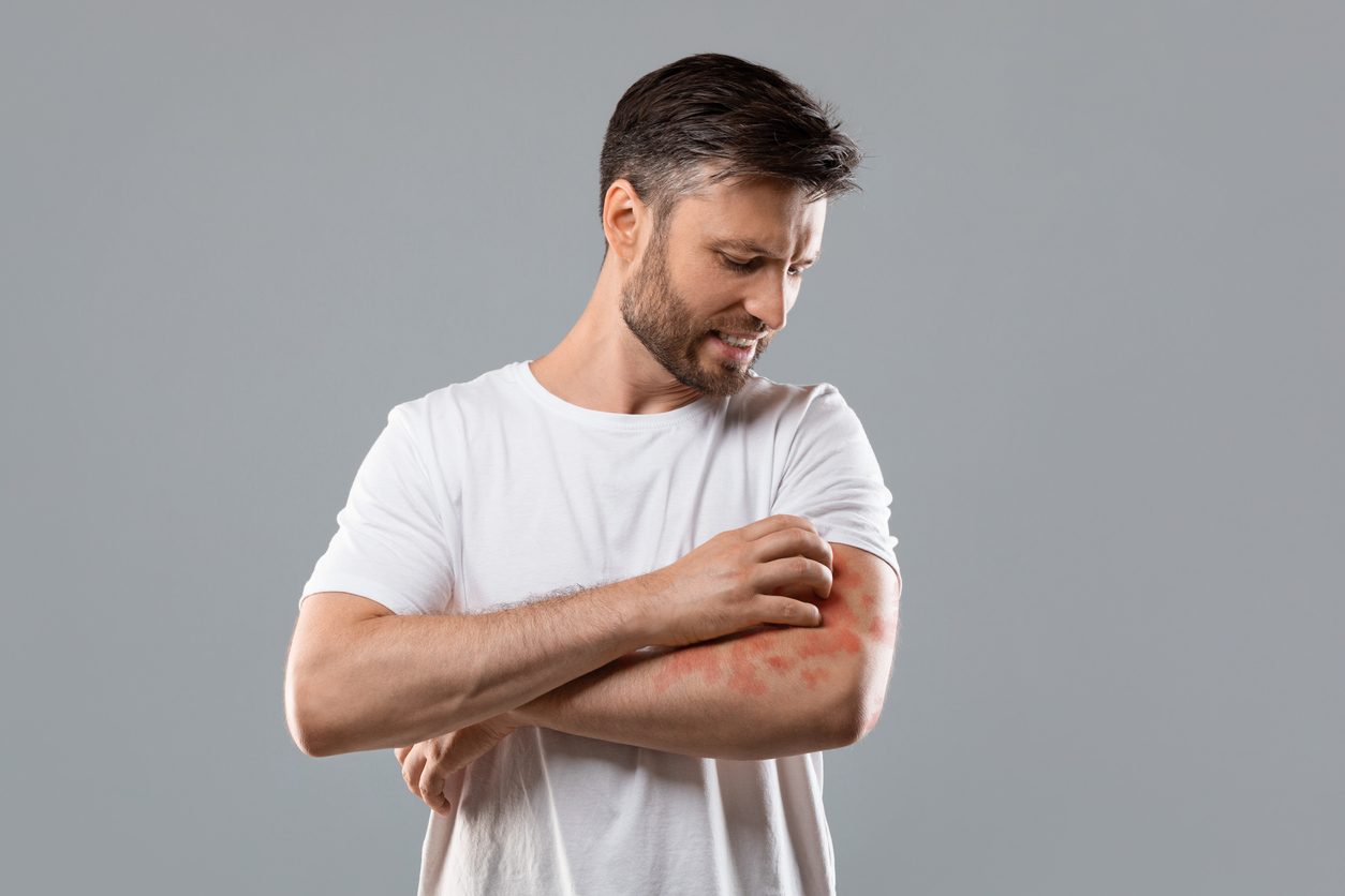 تسبب التهيج وزيادة الحكة والحساسية.. 8 أطعمة عليك تجنبها إن كنت مصاباً بالأكزيما