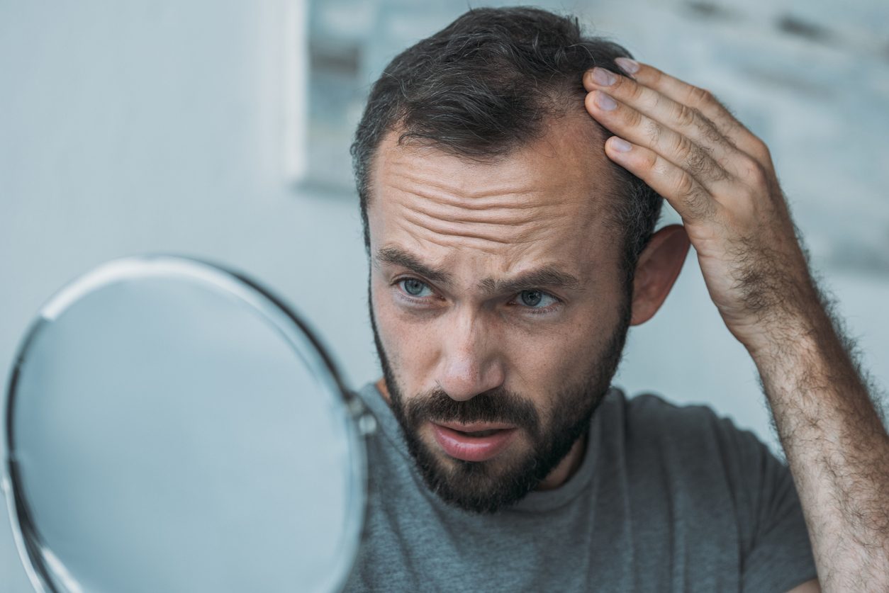 يتساقط الشعر بسببها مخلِّفاً بقعاً صغيرة.. كل ما تريدون معرفته عن داء الثعلبة