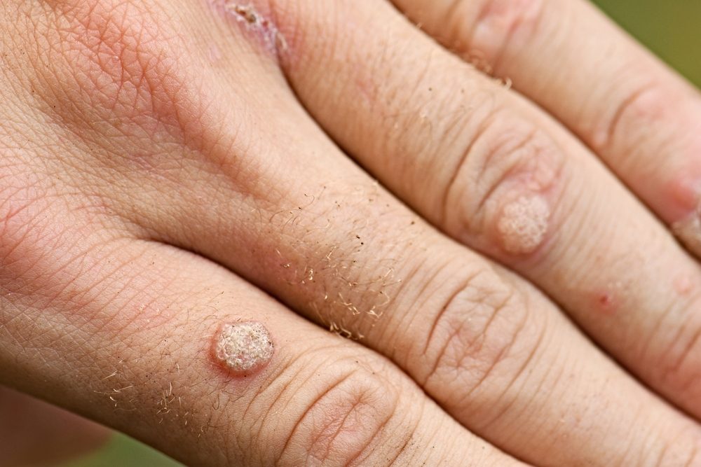 مزعجة وقد تنتشر بسرعة.. 9 طرق منزلية بسيطة تساعدك على التخلص من الثآليل