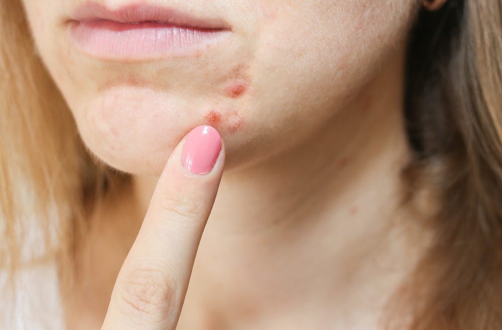 هكذا يمكنك إزالة آثار الحبوب من البشرة باستخدام مكونات طبيعية